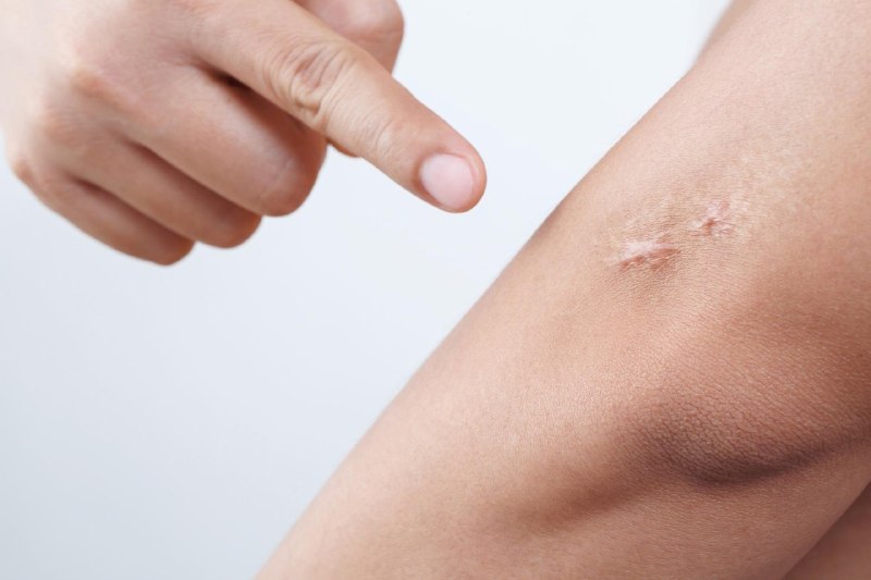 Silicone sheets, petroleum jelly or Vitamin E: What actually helps scars fade?